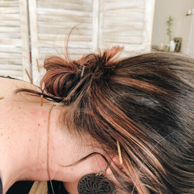 Dry Needling for Tension Headache Relief